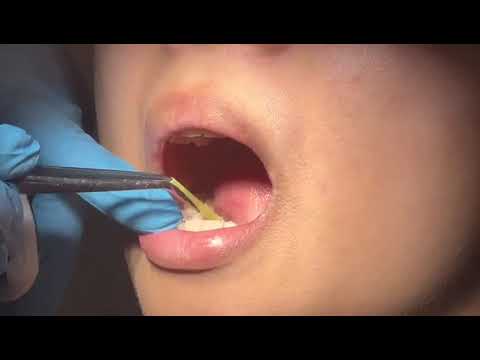 TONGUE TIE RELEASE