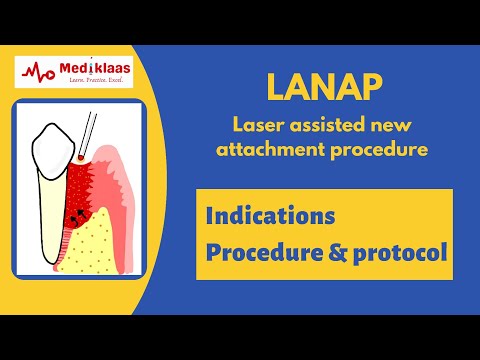 LANAP (Laser assisted New Attachment procedure) l Periodontal Regeneration l Mediklaas