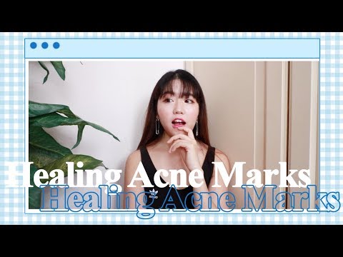 How to: Heal Acne Marks (Post-Inflammatory Hyper-Pigmentation) 💫 | thatxxRin