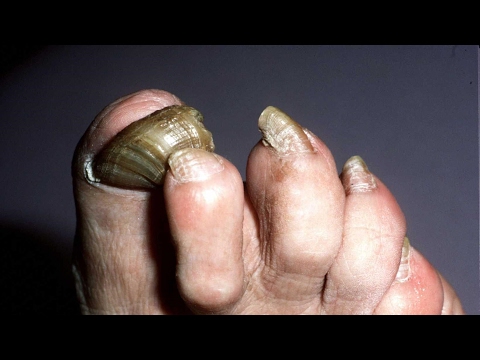 Alternative treatments, such as the toenail fungus tea tree oil cure