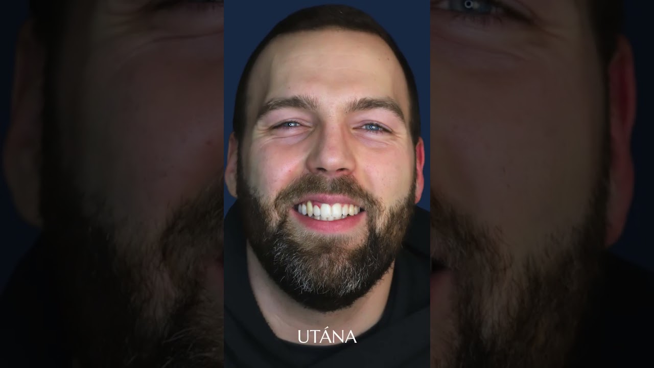 Láthatatlan fogszabályozás - páciens élmény videó - Dr. Kovács Sarolta #utazás #komplex #eset