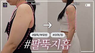 [어깨, 팔뚝,부유방,견갑, 등, 쇄골라인] 지방흡입