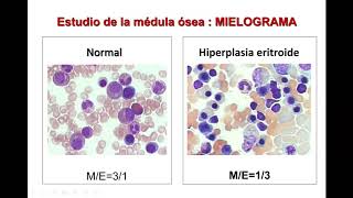 Anemias megaloblásticas (Parte 2)