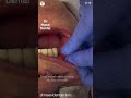 Dental abscess, cheek swelling