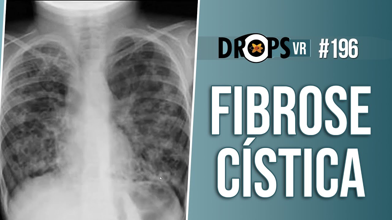 ALTERAÇÕES TÍPICAS DE FIBROSE CÍSTICA NO RX E NA TC
