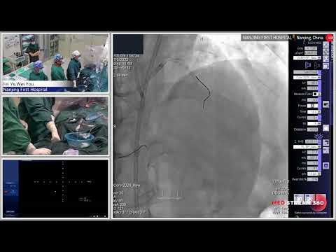 PCI of the Calcified CTO
