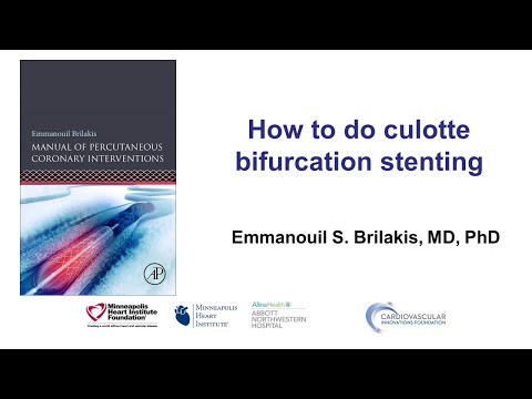 How to do culotte bifurcation stenting