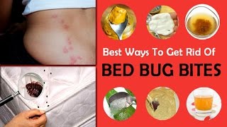 How to Treat Bed Bug Bites With Home Remedy.