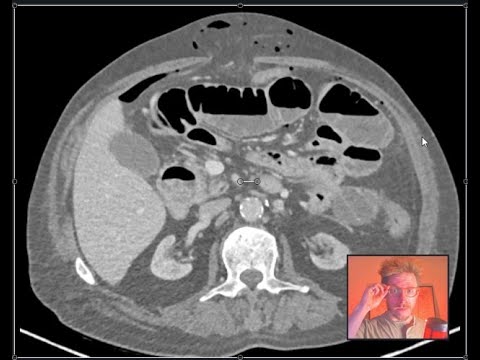 5 achados em uma tomografia de abdome
