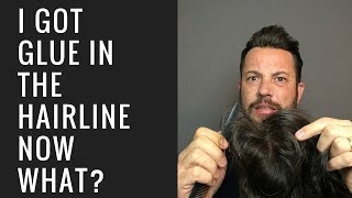 Hair Replacement Mens Hair System Review I Got Glue In The Hairline, Now What?
