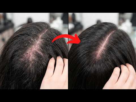 🔥#1 SI TË TRAJTOJMË zbokthin në shtëpi | Si të shpëtojmë nga zbokthi | Ilaçet shtëpiake kundër zbok