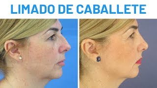 Limado de Caballete | Resultados de Clínicas Diego de León