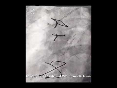 Angioplasty of Saphenous vein graft of RCA