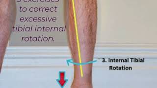 3 corrective exercises for excessive tibial internal rotation