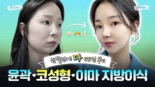 윤곽 3종 + 코성형 + 이마 지방이식｜붓기/멍/일상복귀, 현실 체크