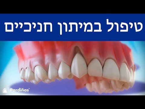 טיפול במיתון חניכיים ©