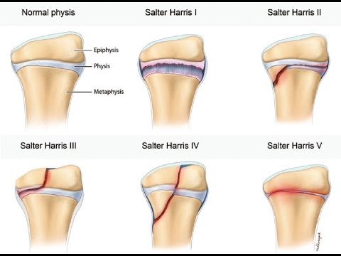 SALTER - HARRIS CLASSIFICATION OF FRACTURES