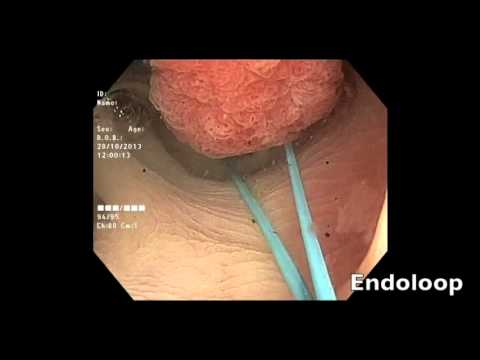 comment soulager diverticules