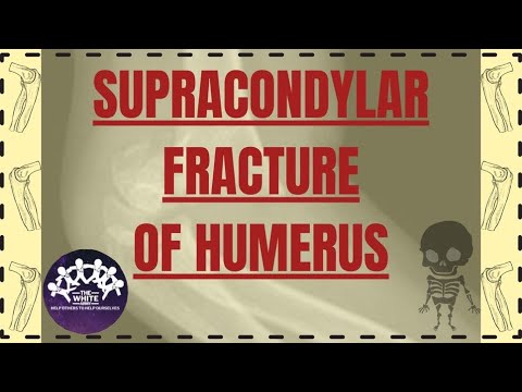SUPRACONDYLAR FRACTURE OF HUMERUS - Revision before Examination