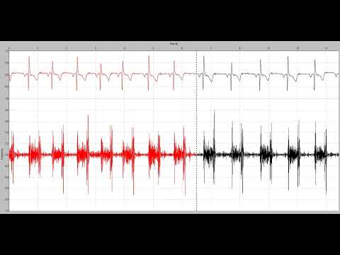 Holosystolic (pansystolic) murmurs start at S1 and extend up to S2 | hear with handfree