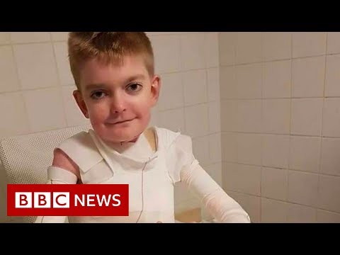 剥離症状の少年に1万8000枚のカードを送る - BBC ニュース (Boy with skin-peeling condition sent 18,000 cards - BBC News)