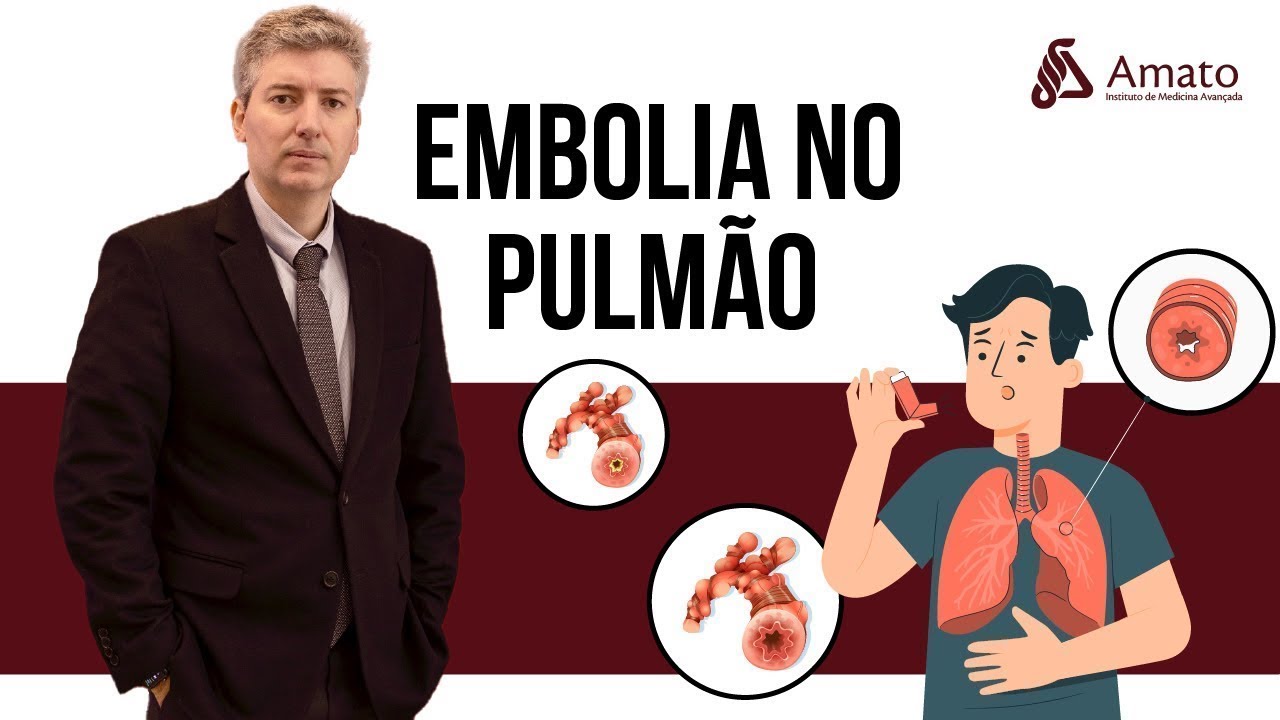 Embolia Pulmonar Aguda, como evitar essa catástrofe?