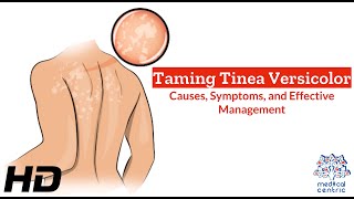 Tinea Versicolor Unveiled: Causes, Symptoms, and Solutions