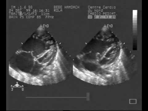 Biventricular Noncompaction with Pulmonary Hypertension and Tricuspid Regurgitation. Part 1/3