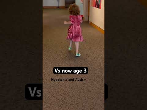 Can you see the difference? Time is what helps #shorts #specialneeds #hypotonia #toddlers #running