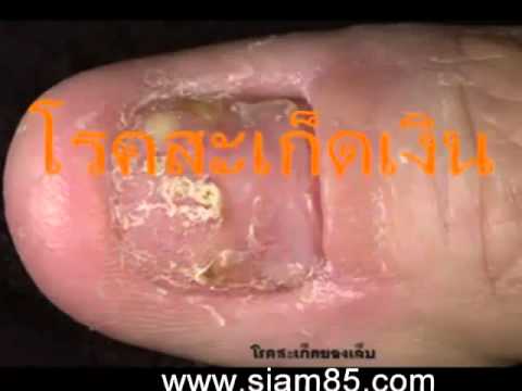 รักษากลากอิสราเอล ผมยาวหนังศีรษะโรคสะเก็ดเงิน