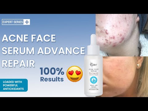 Vrh paste acne cleanser, normal skin, packaging size: tube b...