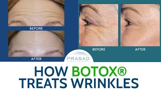 How Botox Treats Wrinkles