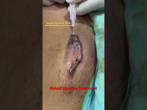 Keloids Scar Treatment