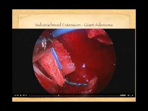 Advances and Limitations of Endoscopic Pituitary Surgery