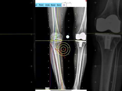 OsteotomyApp