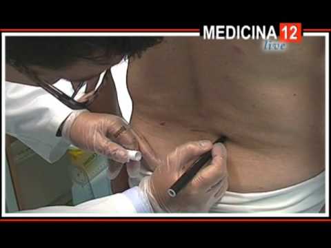 Fare jogging dopo la sostituzione dellanca Kashpirovskiy tratta osteocondrosi