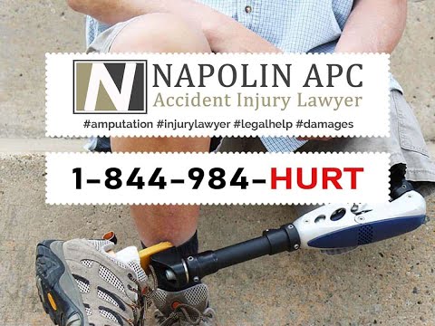 Napolin Amputation Injury Lawyer | Life And Legal Action After An Amputation Injury | Riverside