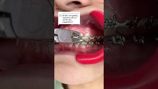 Download lagu Tips you'll WANT to know if you're Getting your Braces Off mp3 Download lagu Tips you'll WANT to know if you're Getting your Braces Off mp3