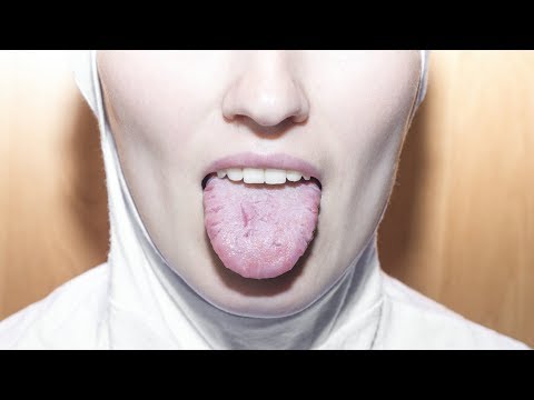papilloma gola intervento motive papiloame