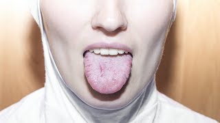 Limba geografica = predispozitie pentru cancer oral?