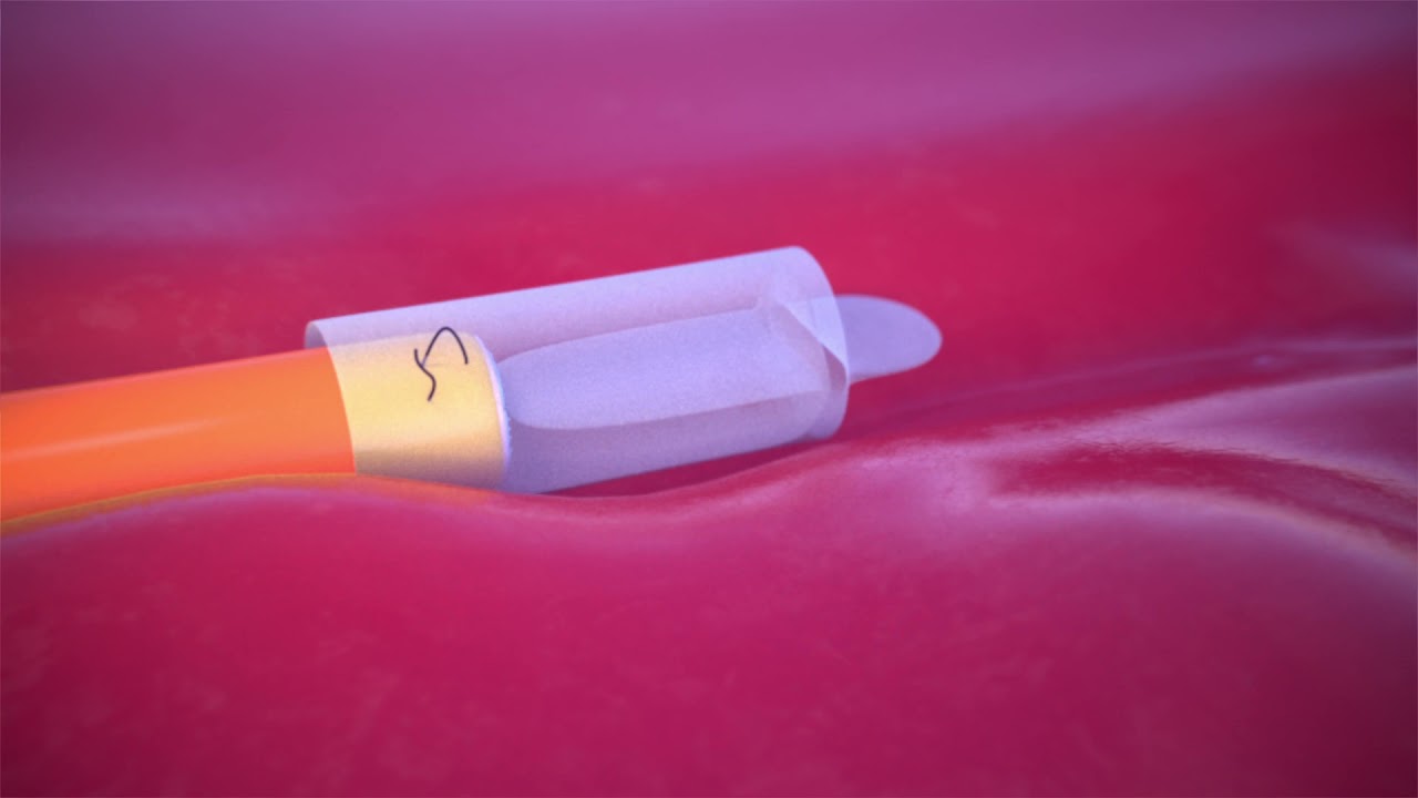 Axoguard Nerve Cap®