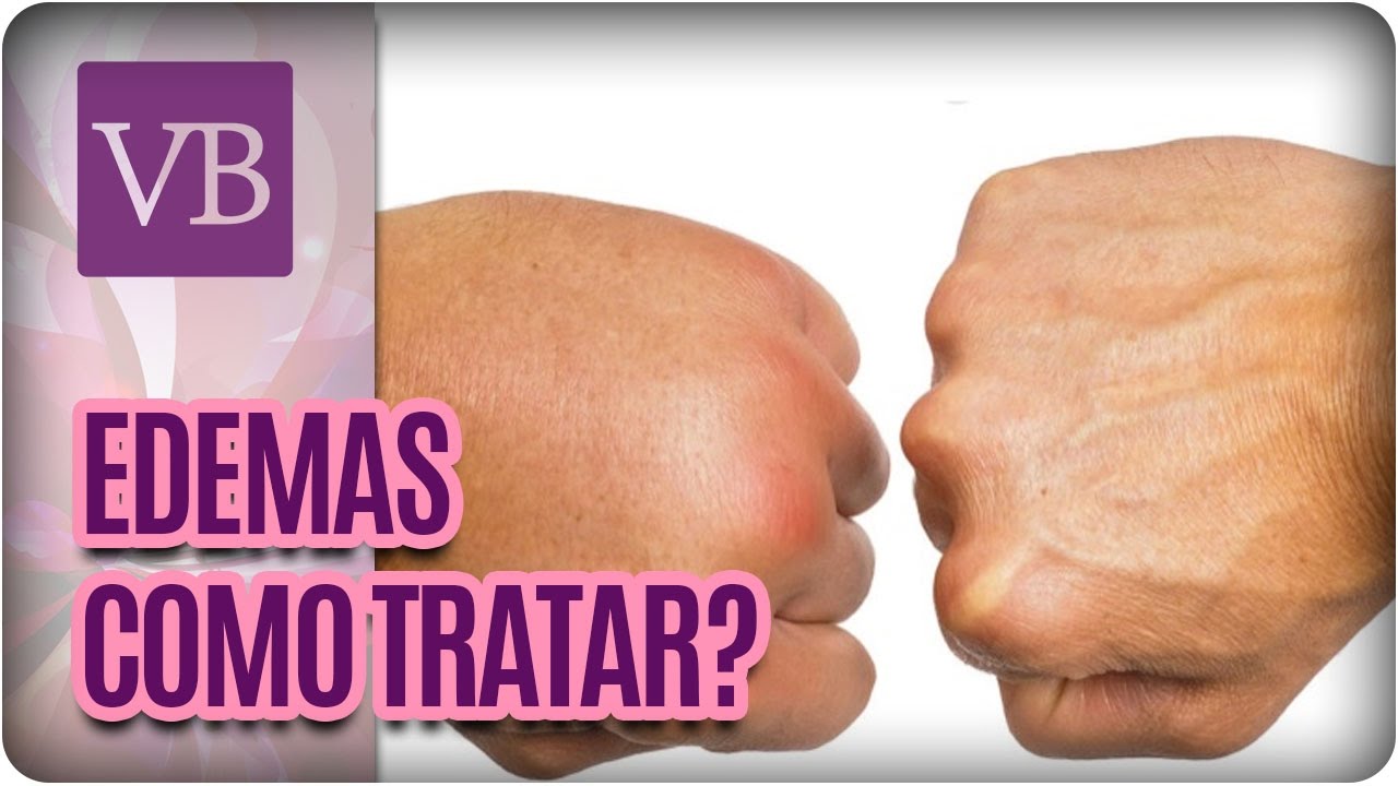 Edemas: O que é, Causas e Tratamentos - Você Bonita (16/01/17)