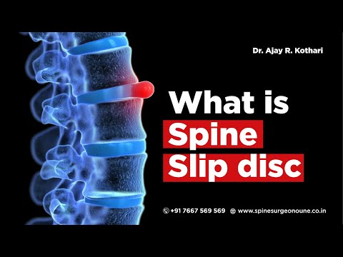 What is Spine Slip disc: A to Z information