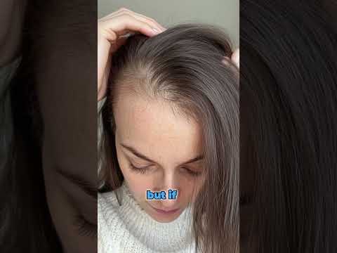 Haarausfall bei Frauen | Genetik und DHT erklärt | Kopfhaut