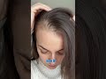 FEMALE HAIR LOSS GENETICS AND DHT EXPLAINED TOP SCALP