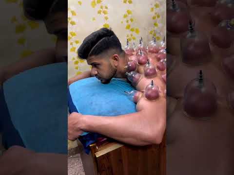 cupping therapy #usmanfitness #mohdnadeem_05 #foryou #cuppingtherapy #youtubeshorts