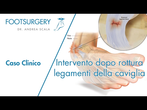 Integratori per giunti in attività sportive Sinovite transitoria della caviglia