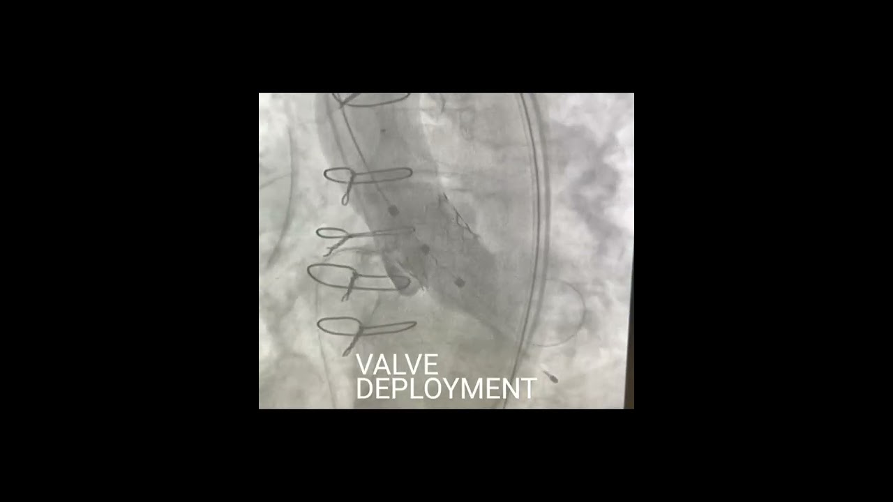 TAVI : Transcatheter aortic valve replacement