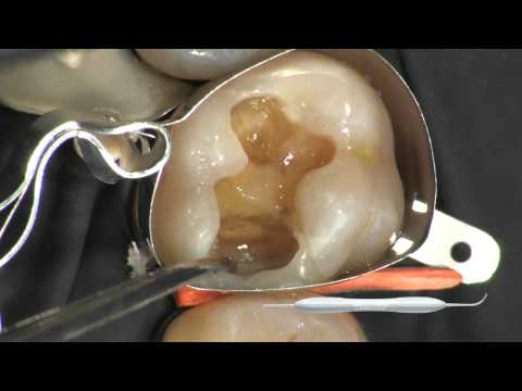 LM-Arte Condensa (LM 488-489 XSI), Инструмент для моделирования композитов (длинный и круглый штопфер), LM-Dental - фото 1 - id-p2909660892