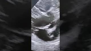 Download lagu 'PLAX view in 2D echocardiography too see Aortic Valve and MV ! #2DEcho #PLAXView #Cardiology' mp3 Download lagu 'PLAX view in 2D echocardiography too see Aortic Valve and MV ! #2DEcho #PLAXView #Cardiology' mp3